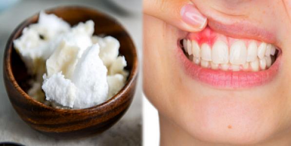 Diş həkimindən xəbərdarlıq: Şəkərdən istifadə edirsinizsə,
