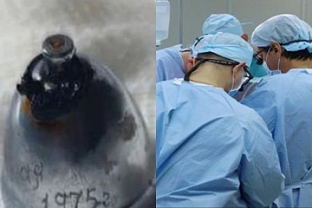 Kişinin ağciyərindən metal zınqırov çıxarıldı -