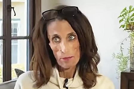 Xərçəng xəstəsi olan qadın