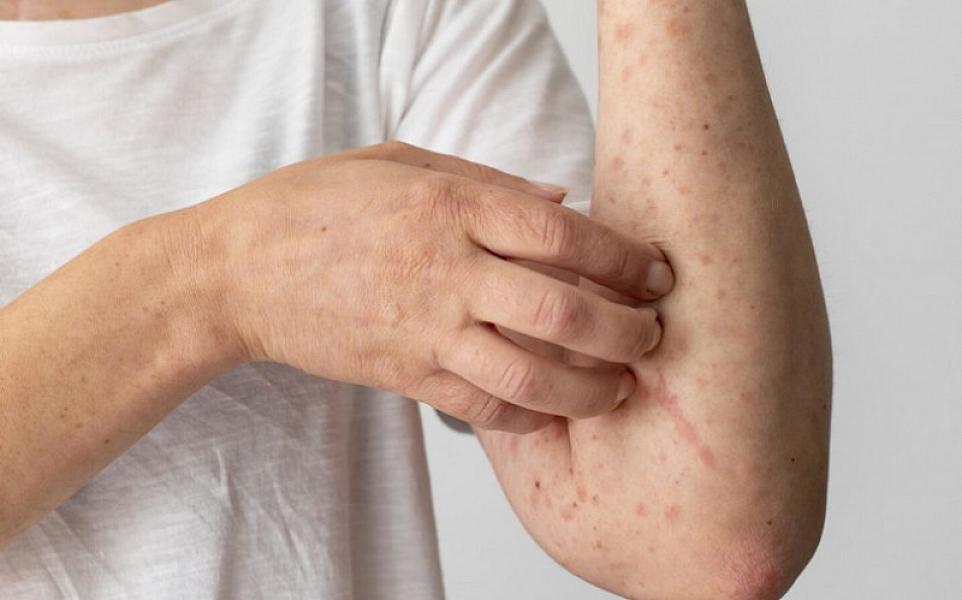 Epidemioloq: "Qızılca istənilən yaşda müşahidə edilə bilər"