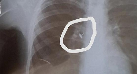 Azərbaycanda həkim yad cisim udan uşağa