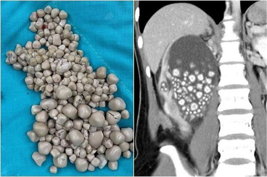 Qadının böyrəyindən 300 daş çıxarıldı –