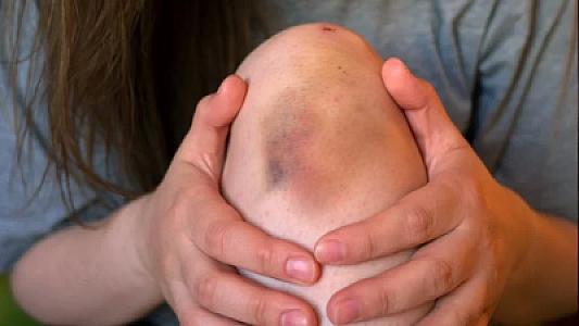 Uşaqlarda göyərmə və qanaxma