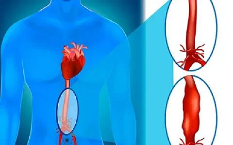 Nəzarət olunmayan təzyiq aortanın yırtılmasına səbəb ola bilər -