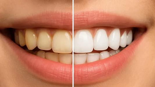 ​​​​​​​Sağlam zənn etdiyiniz bu qidalar dişlərinizi