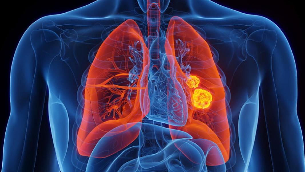Aspirin bəzi xərçəng növlərinin yayılmasının qarşısını ala bilər -