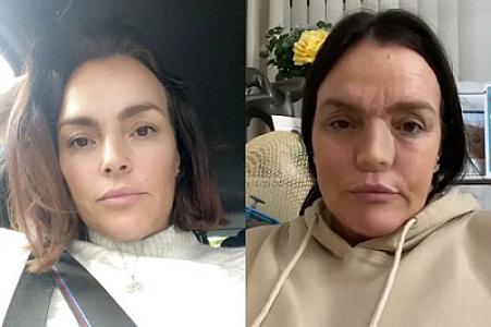 İngiltərədə qadın uzun müddət sürən zökəmdən sonra burunsuz qalıb - DƏHŞƏT +