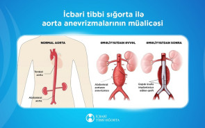 Aorta anevrizmalarının protezləşdirilməsi ilə bağlı