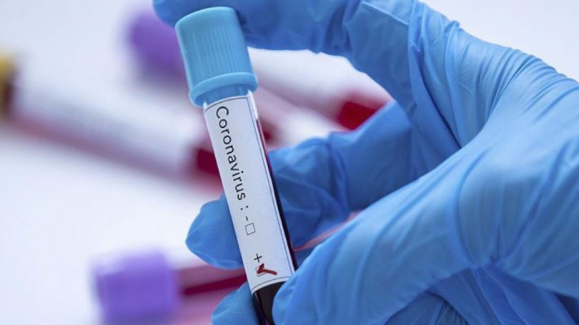 Azərbaycanda daha 15 nəfər koronavirusa yoluxub, ölən olmayıb