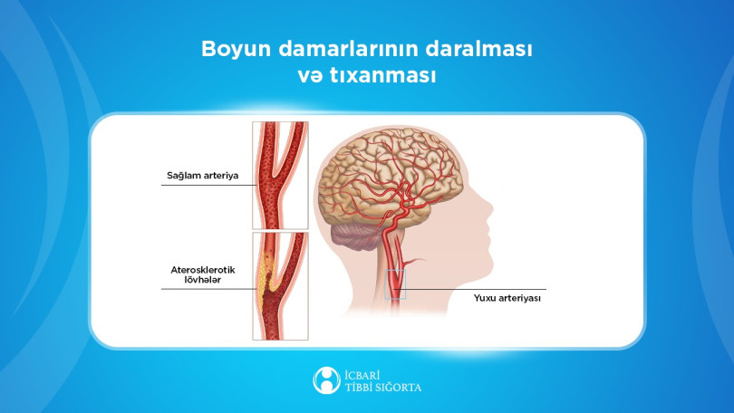 Beyin qan dövranı pozulmalarının diaqnostika və müalicəsi