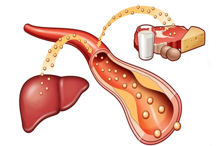 "Pis" xolesterolu tez və dərmansız