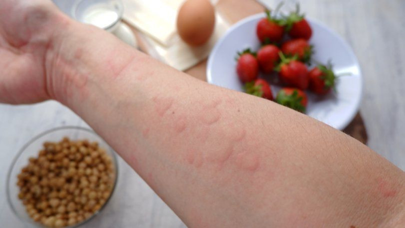 Allergiya zamanı allergik əlamətləri artıran qidaların