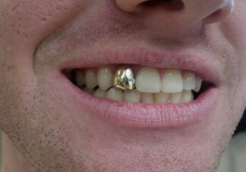 Ağ dişin qızıl dişdən