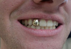 Ağ dişin qızıl dişdən